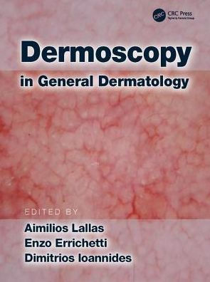 Dermoscopy in General Dermatology by Aimilios Lallas