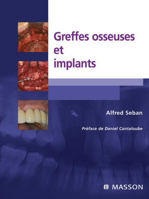 Greffes osseuses et implants By Alfred Seban