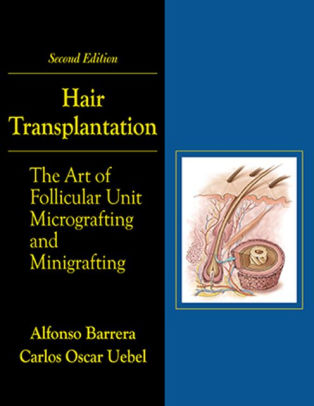Hair Transplantation 2nd Edition by Alfonso Barrera