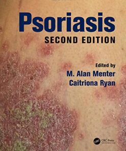 Psoriasis 2nd Edition by M. Alan Menter