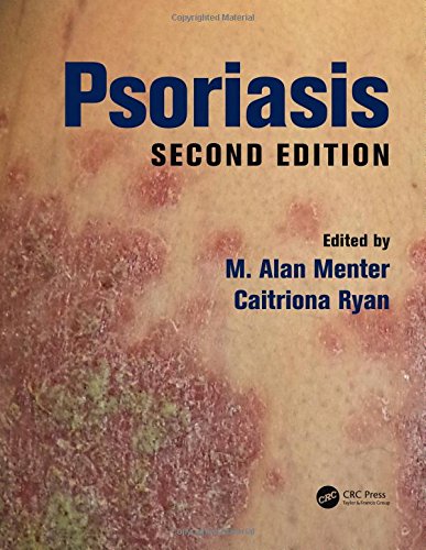 Psoriasis 2nd Edition by M. Alan Menter